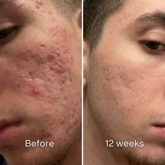 Clinical Acne Scar Removal Stick