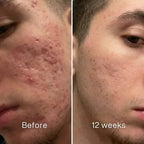 Clinical Acne Scar Removal Stick