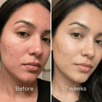 Clinical Acne Scar Removal Stick