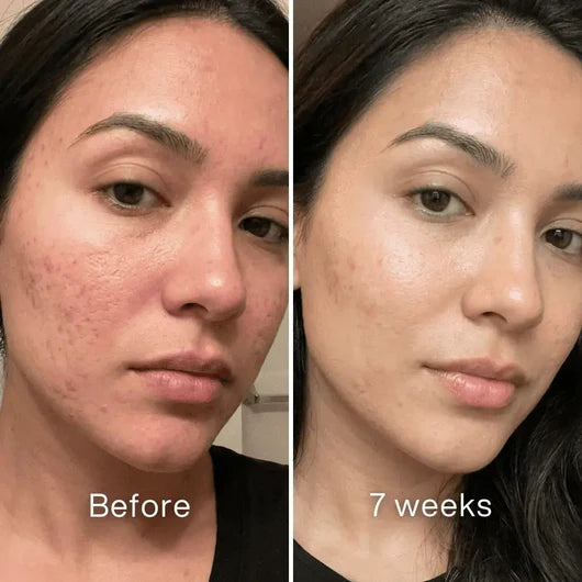 Clinical Acne Scar Removal Stick
